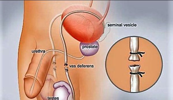 Vazectomia és prostatitis kezelni a partnert a prostatitisben